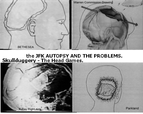 JFK AUTOPSY photos assassination kennedy x rays pic picture head shot wound