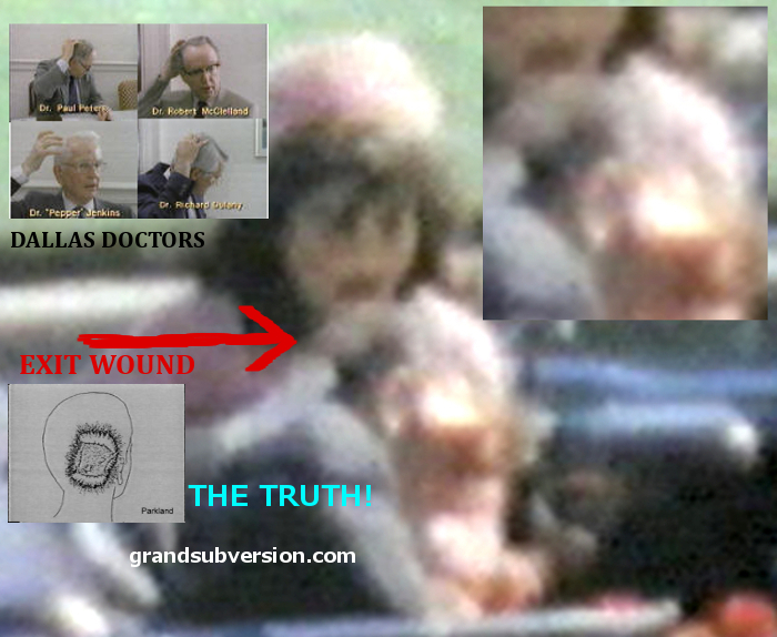 head injury treatment wound gunshot jfk zapruder film footage truth kennedy assassination picture photo