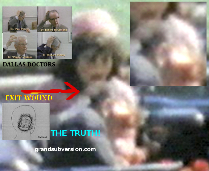 jfk autopsy kennedy head wound ingury headshot death shot from front picture photo gunshot face explodes graphic