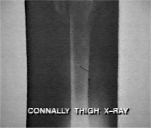 Governor Connally's connally x-ray kennedy assassination jfk  photos pictures gunshot wounds