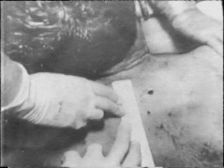 jfk kennedy assassination autopsy back wound  photo 9