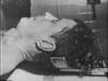 autopsy medical picture photograph pic image jfk assassination 03